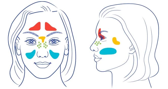 Die häufigsten Symptome einer Nasennebenhöhlenentzündung erkennen