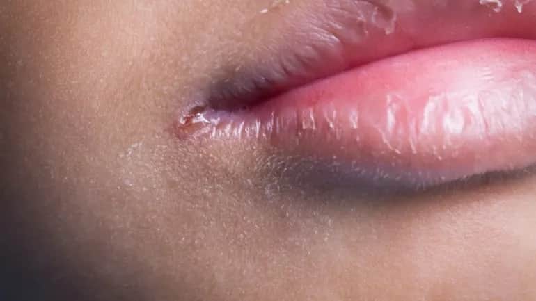 Die häufigsten Symptome bei Folsäuremangel: Warnzeichen erkennen