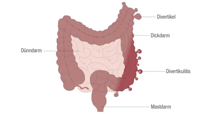 Die wichtigsten Methoden zur Diagnostik von Divertikulose und ihre Risiken