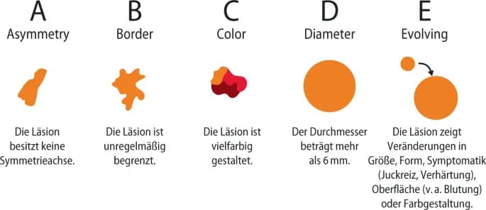 Die entscheidenden Schritte zur effektiven Melanom-Diagnostik verstehen