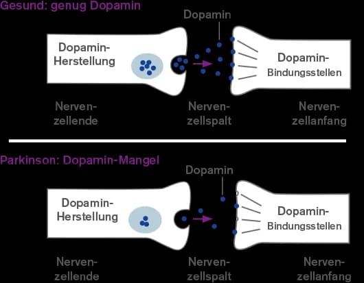 Die entscheidenden Schritte der Parkinson Diagnostik verstehen