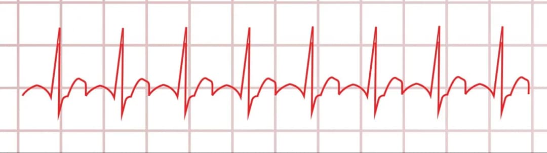 Myokarditis Diagnostik EKG: EKG-Befunde verstehen und richtig deuten