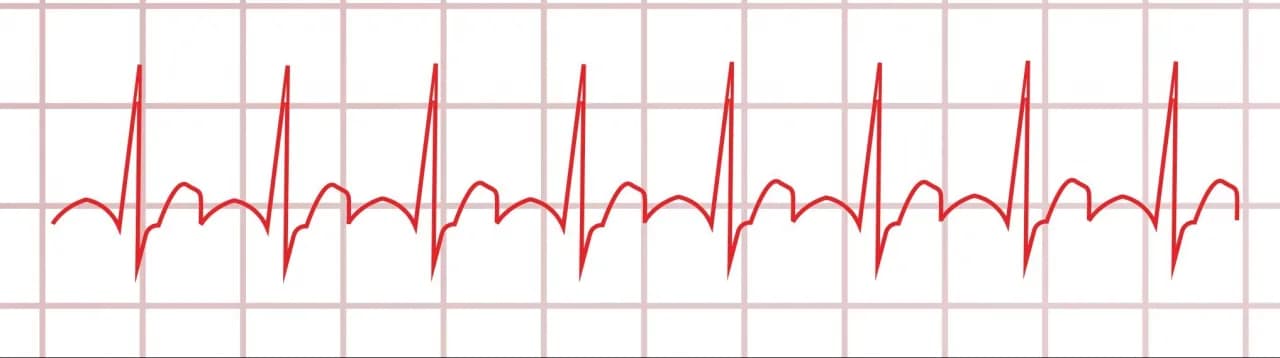 Myokarditis Diagnostik EKG: EKG-Befunde verstehen und richtig deuten