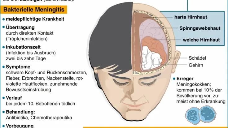 Hirnhautentzündung Diagnostik: So erkennen Sie die Symptome rechtzeitig