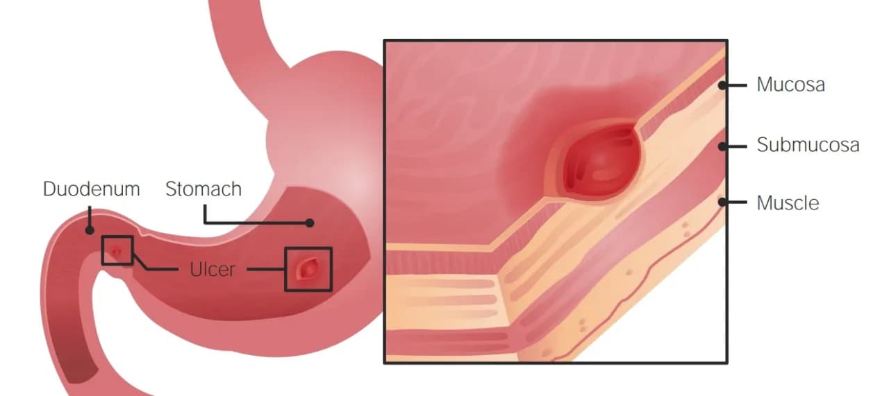 Ulcus duodeni diagnostik: Wichtige Methoden zur Früherkennung von Geschwüren