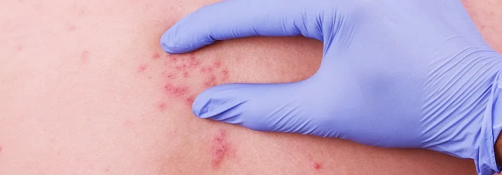 Die besten Medikamente gegen Gürtelrose: Linderung der Schmerzen und Symptome