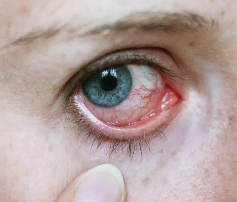 Fibromyalgie Symptome Augen: Unerwartete Beschwerden und Lösungen