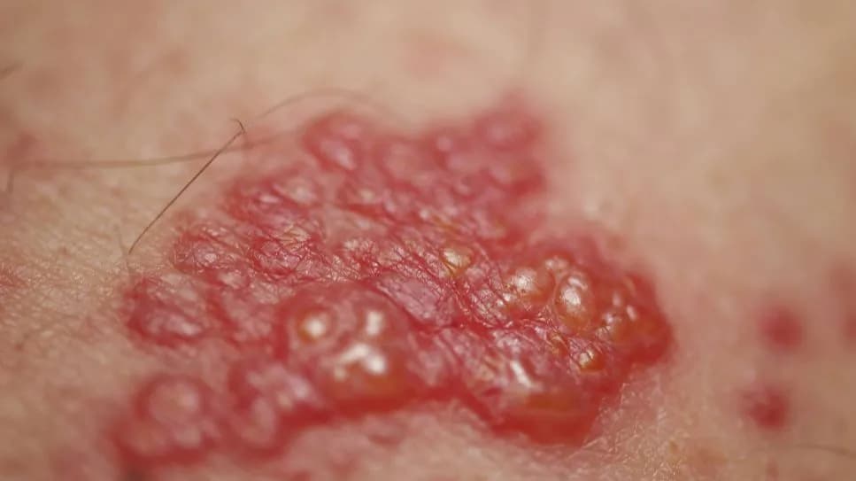 Gürtelrose Medikamente: Effektive Behandlungen und wichtige Hinweise