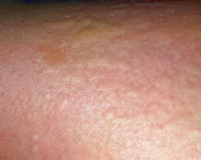 Gluten intoleranz symptome: Erkennen Sie die versteckten Anzeichen