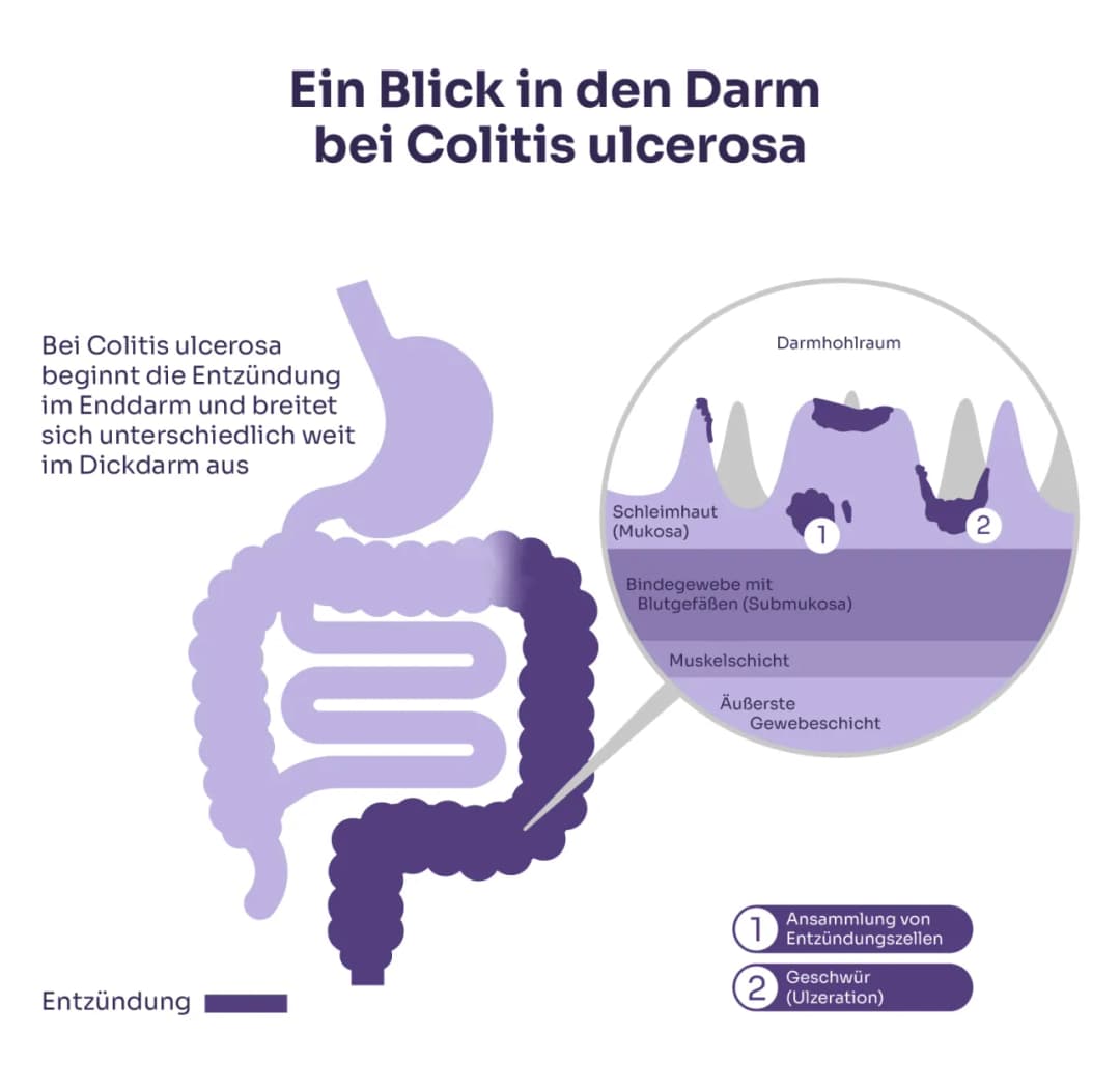 Colitis ulcerosa Symptome: Warnsignale, die Sie nicht ignorieren sollten