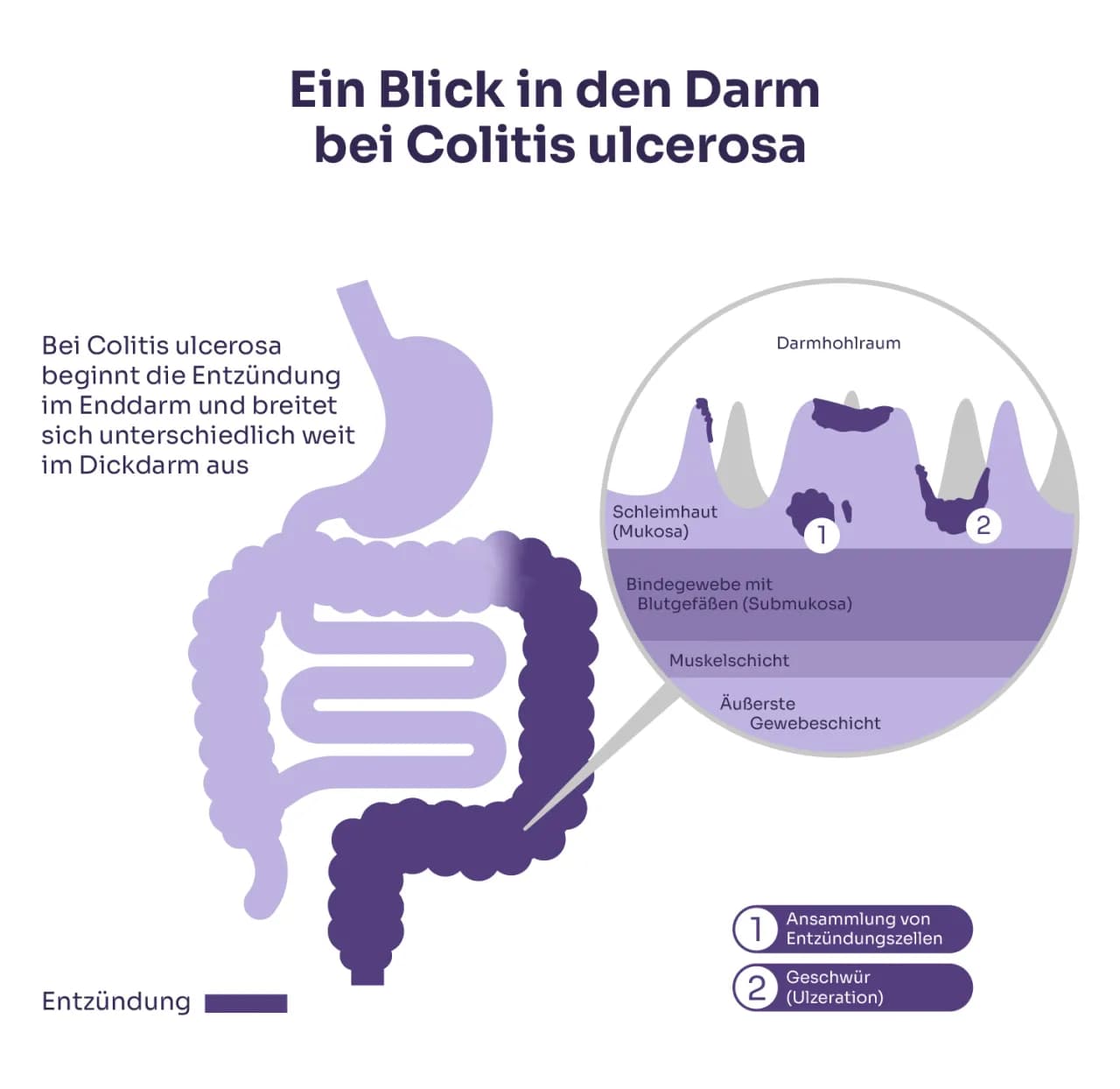Colitis ulcerosa Symptome: Warnsignale, die Sie nicht ignorieren sollten