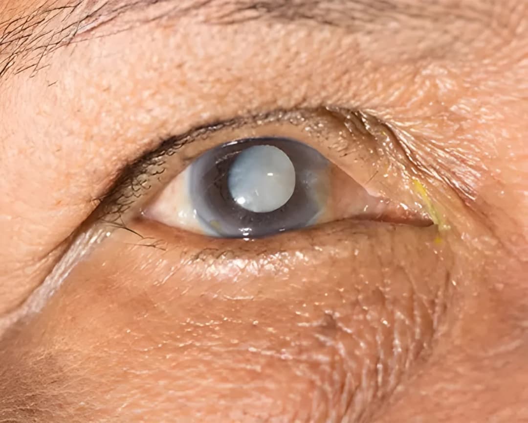 Grauen Star Symptome: Erkennen Sie die Anzeichen rechtzeitig