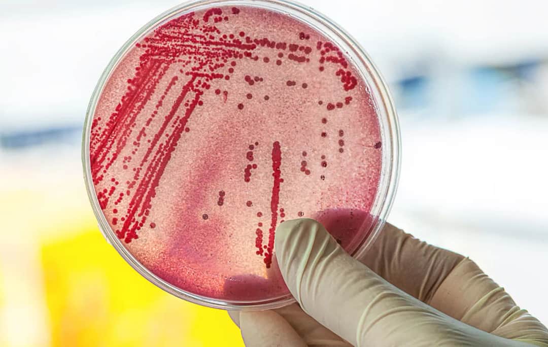 Symptome E. coli: Erkennen Sie die gefährlichen Anzeichen einer Infektion